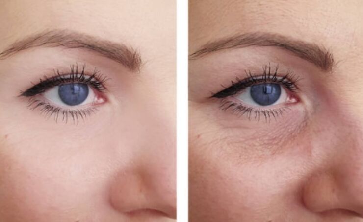 before and after plasma rejuvenation around the eyes