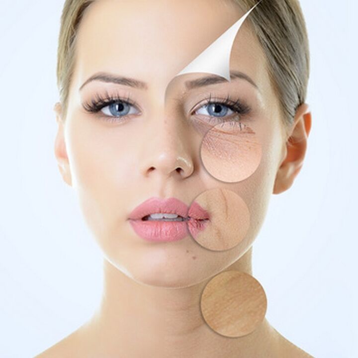 Facial skin imperfections - indications for anti-aging procedures