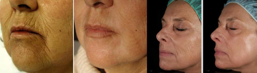 Facial skin before and after laser rejuvenation procedure