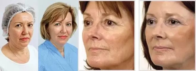 The result of facial skin rejuvenation with laser is the reduction of wrinkles