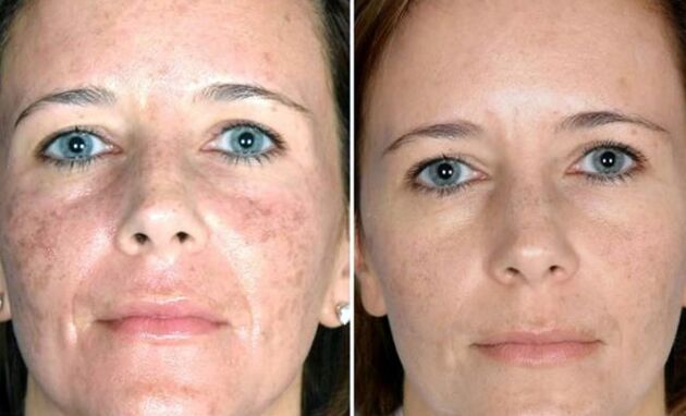 Field laser rejuvenation - before and after