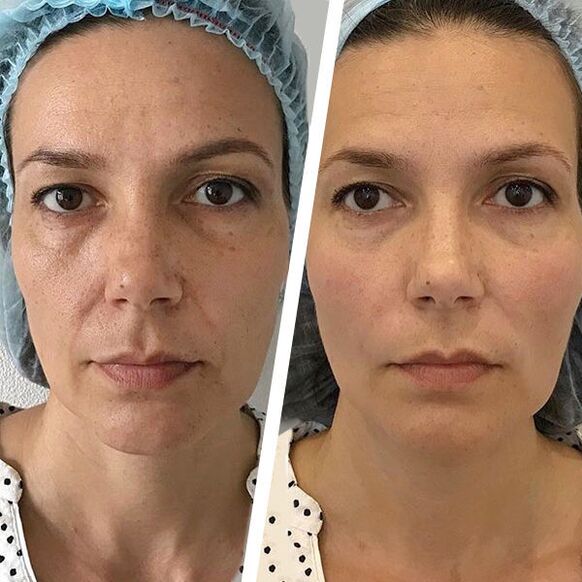 Laser rejuvenation
