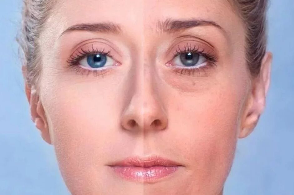 Backs under the eyes