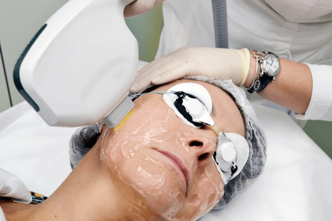 laser rejuvenation for facial skin