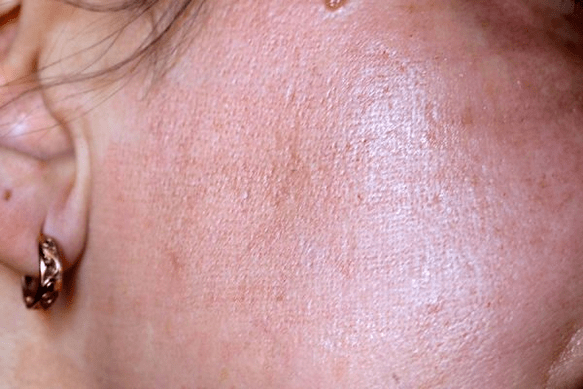redness of the skin after laser rejuvenation