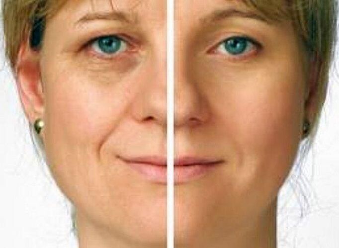 skin around the eyes before and after rejuvenation