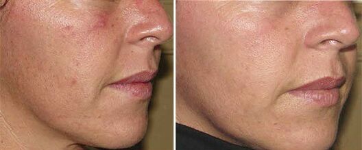 face before and after hardware skin rejuvenation