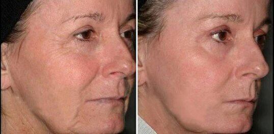result of laser skin rejuvenation