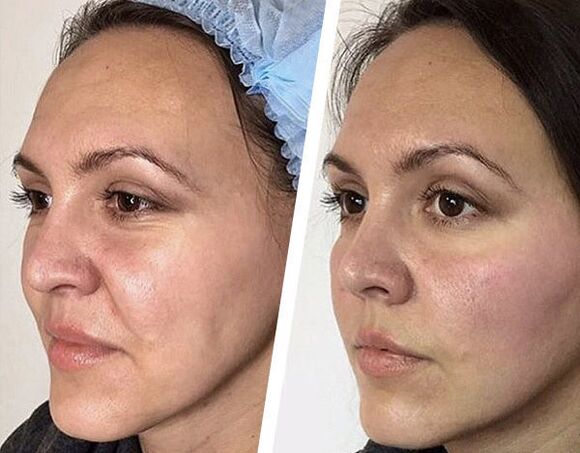 Before and after mesotherapy